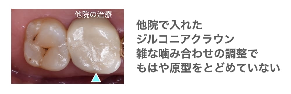 ジルコニアクラウン