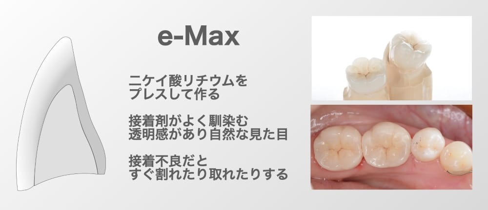 オールセラミック（e-max）