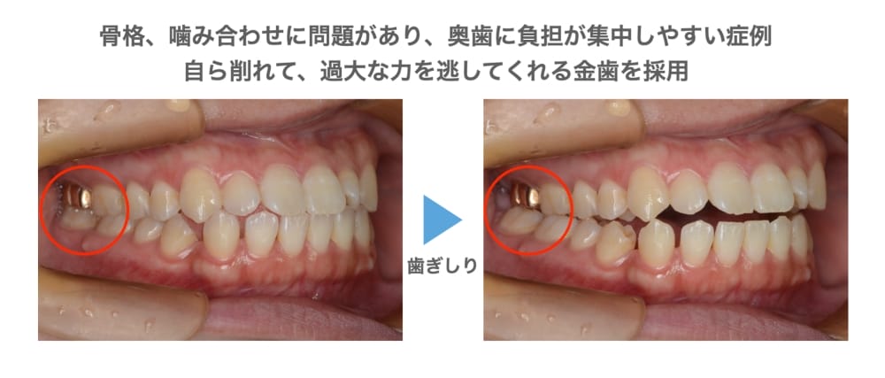 金歯を採用