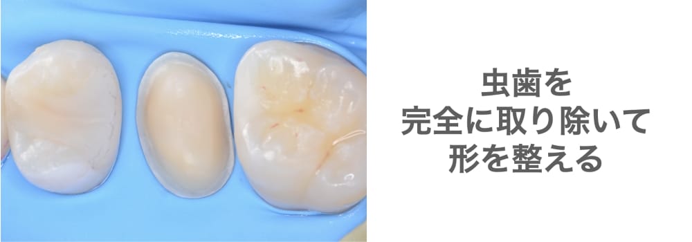 虫歯を取り除き整える