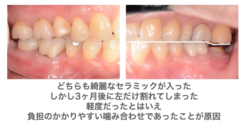 割れてしまったセラミック