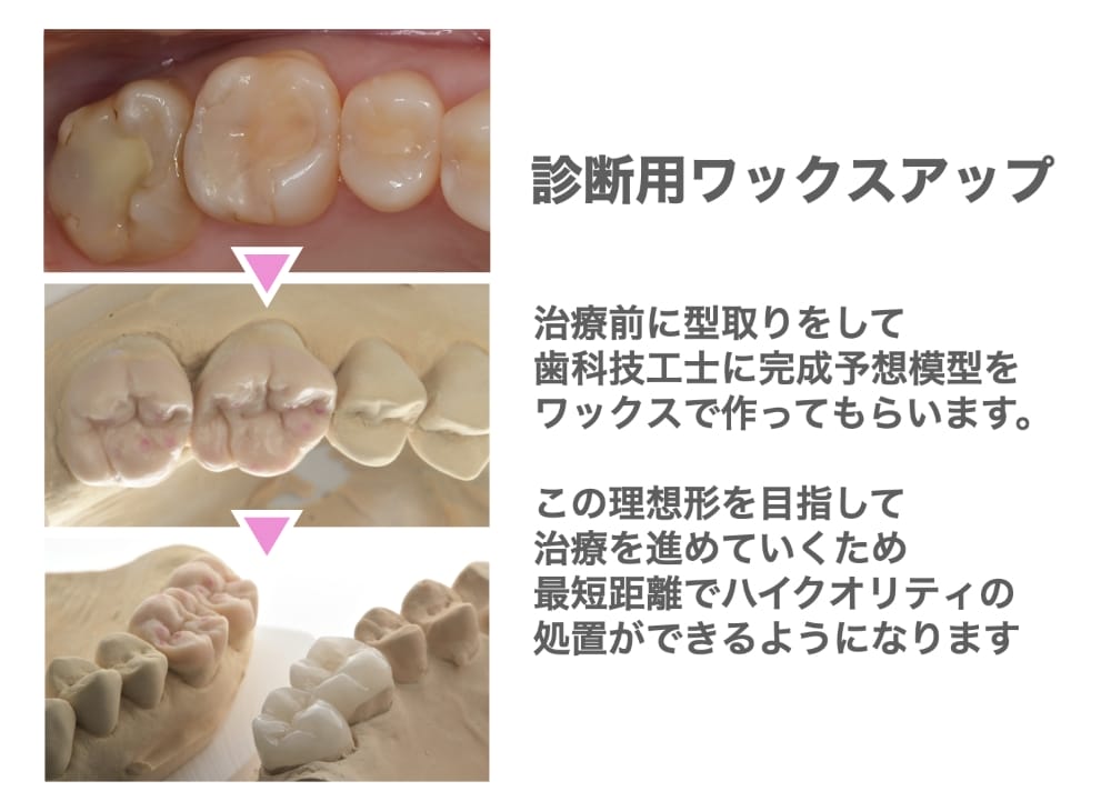 診断用WAXUPで治療ゴールを設定