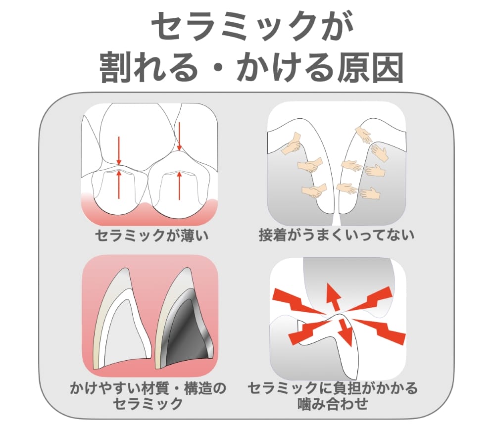 セラミックが割れる・かける原因