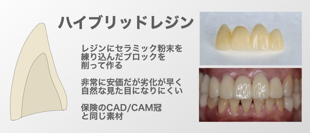 ハイブリッドセラミック（CAD/CAM冠）
