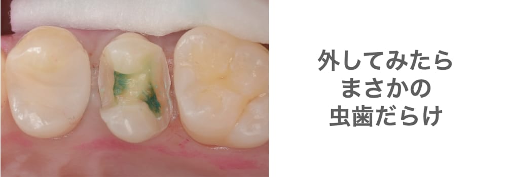 虫歯だらけの写真