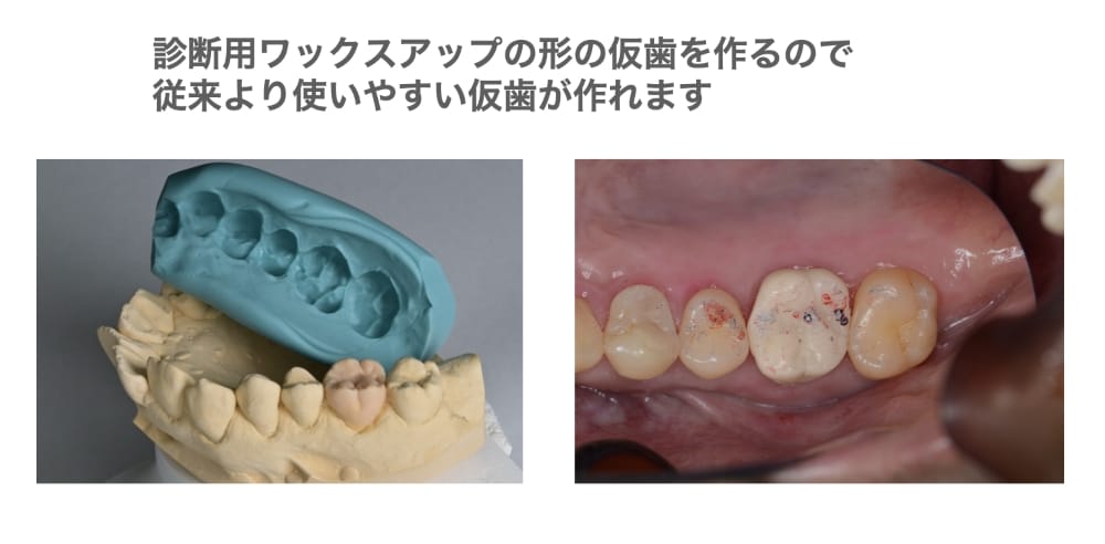 従来より使いやすい仮歯