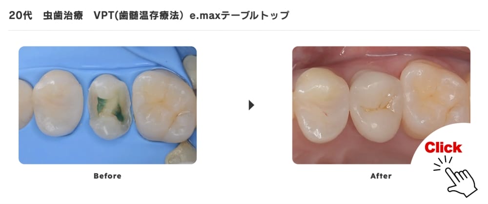 虫歯治療VPT