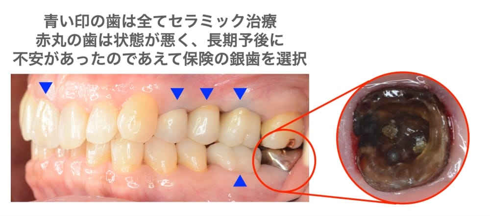 あえて銀歯を選択
