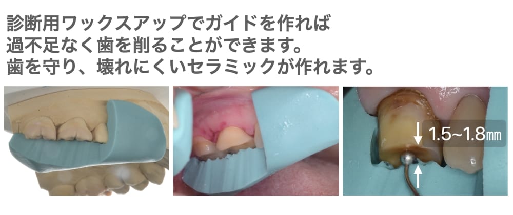 診断用WAXUPでガイドを作る