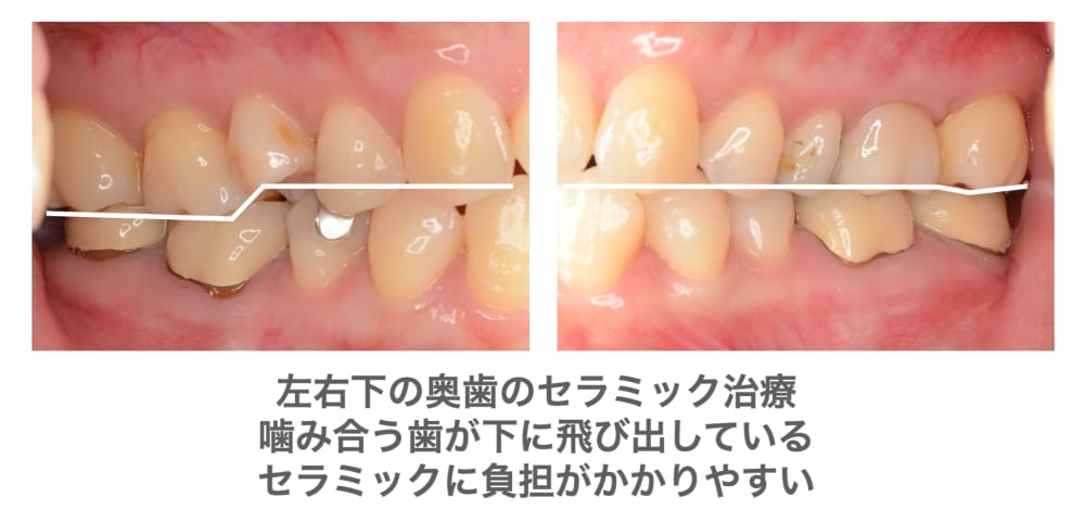 セラミック治療