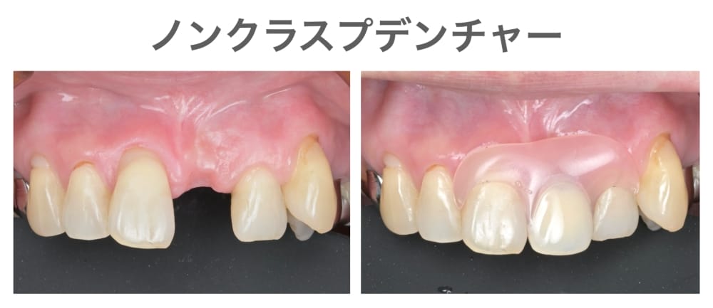 ノンクラスプデンチャー