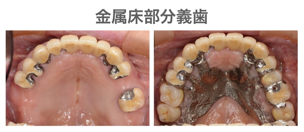 金属床部分義歯