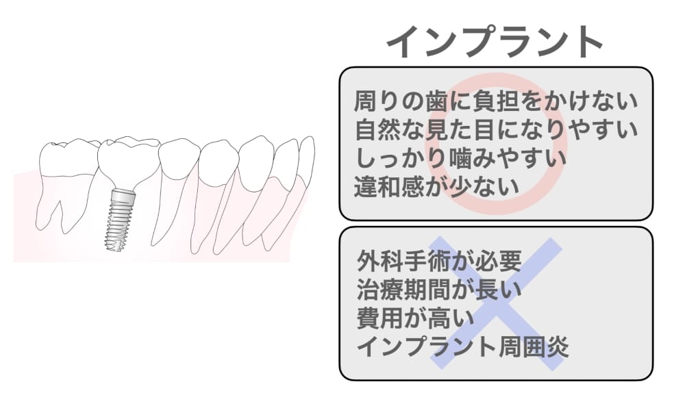 インプラント