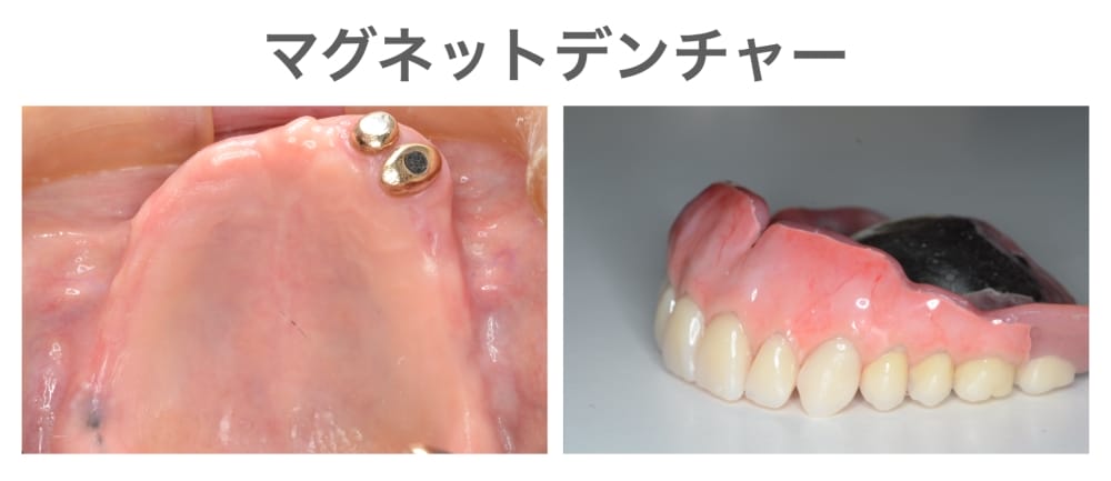 マグネットデンチャー