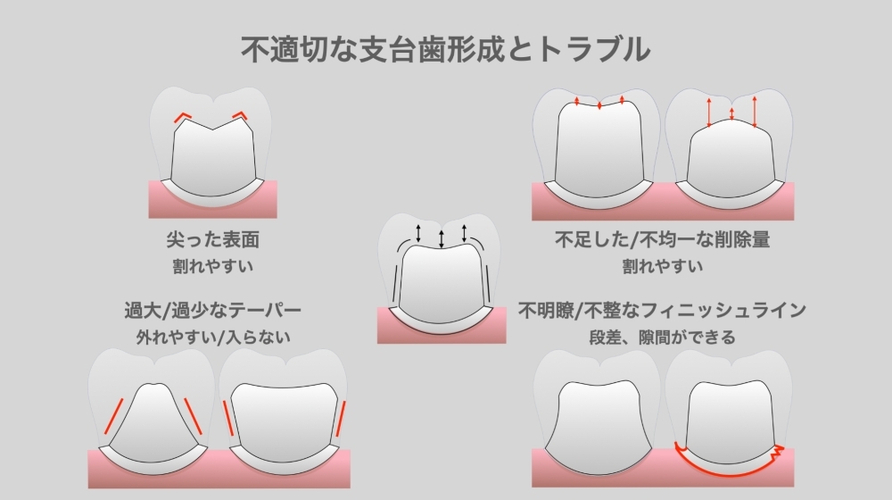 image_tooltip 不適切な支台歯形成とトラブル