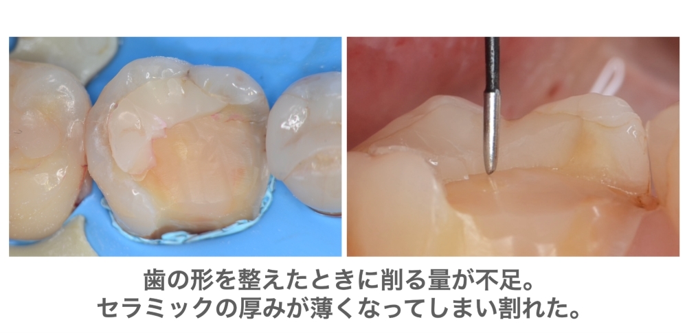 image_tooltip 歯の形を整えたときに削る量が不足