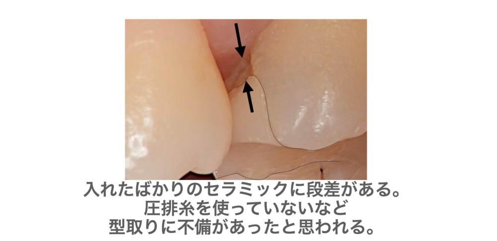image_tooltip 入れたばかりのセラミックに段差がある