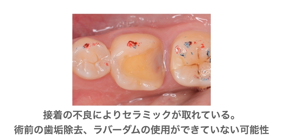 image_tooltip 接着の不良によりセラミックが取れている