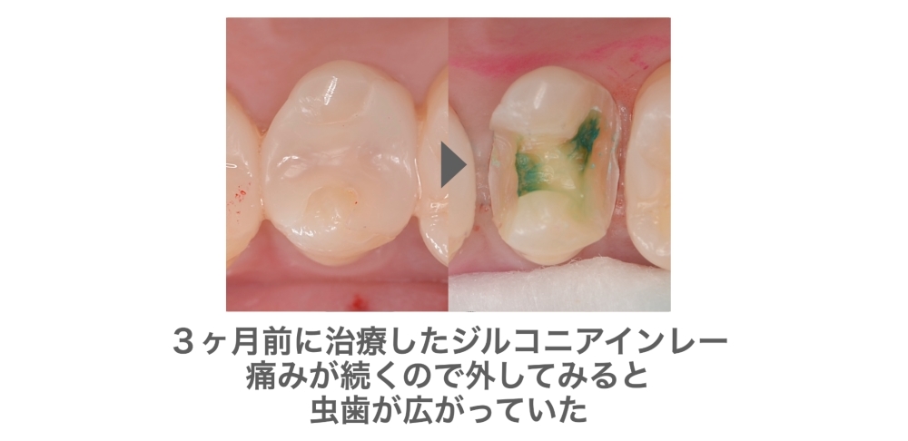 image_tooltip 3ヶ月前に治療したジルコニアインレー