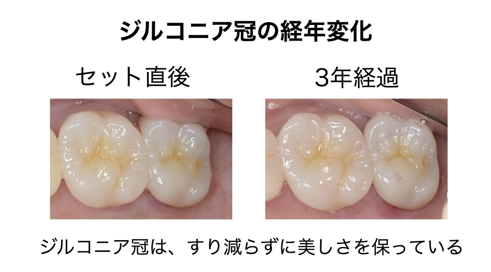 image_tooltip ジルコニア冠の経年変化