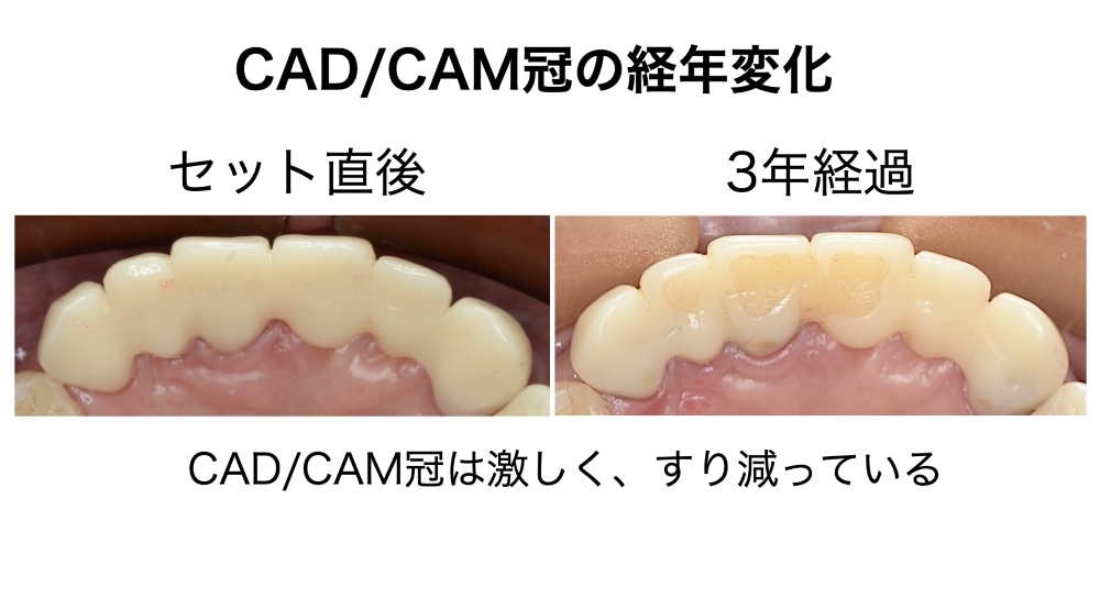 image_tooltip CAD/CAM冠の経年変化