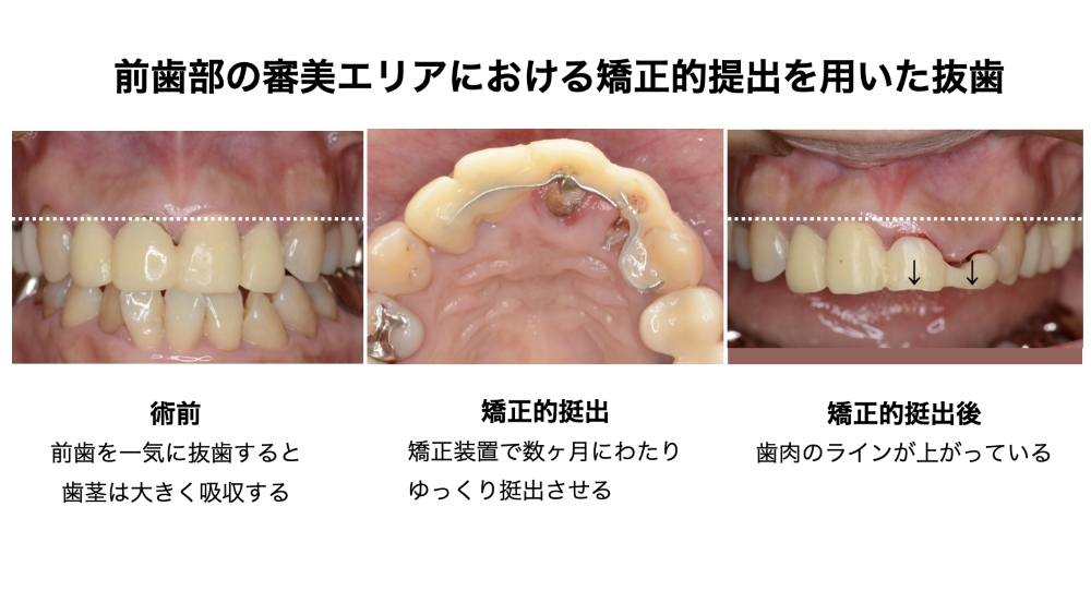 前歯部の審美エリアにおける矯正的提出を用いた抜歯