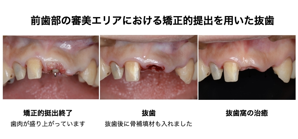 前歯部の審美エリアにおける矯正的提出を用いた抜歯