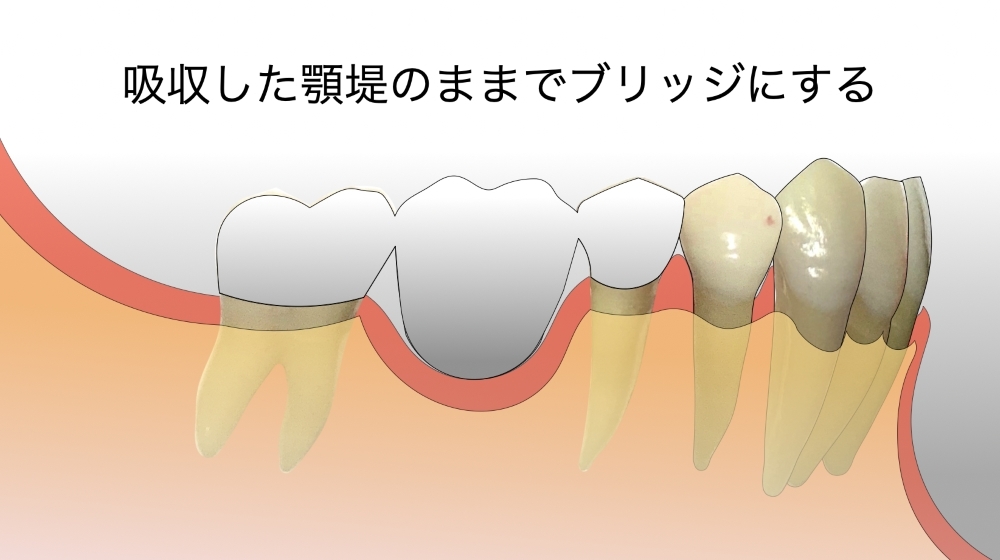 吸収した顎堤のままでブリッジにする