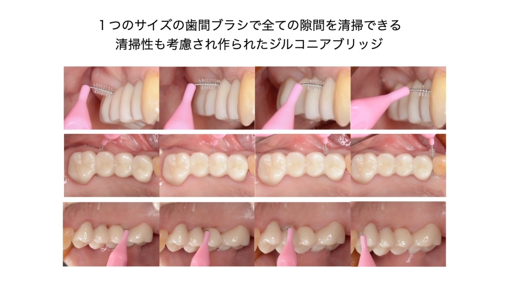 設計を工夫することで一つのサイズの歯間ブラシで全ての隙間を無理なく楽に清掃できるように考慮してブリッジを作ることもできます。