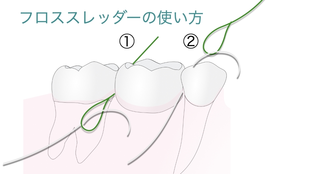 フロススレッダーの使い方