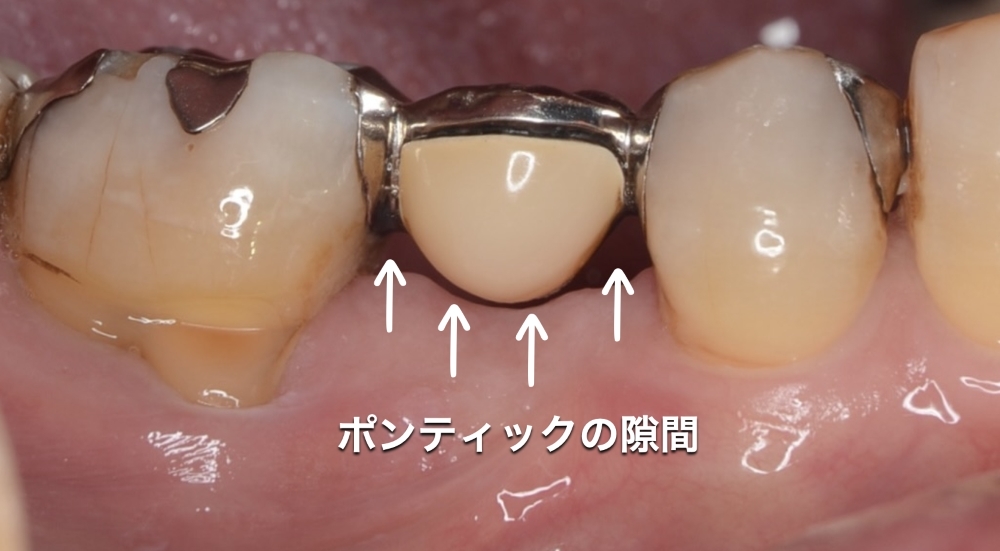ブリッジの隙間はわざと空けられていることがあります