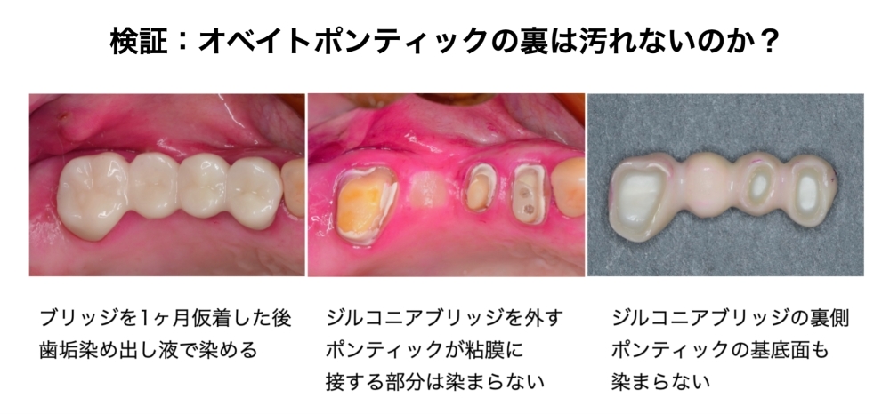 オベイトポンティックの裏は汚れないのか？