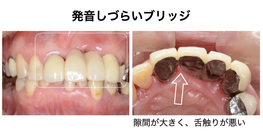 発音しづらいブリッジ