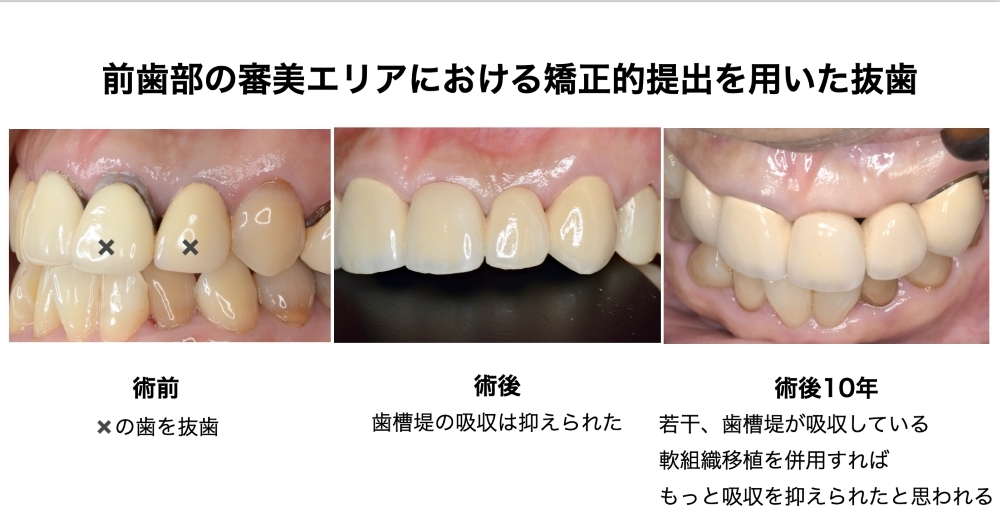 前歯部の審美エリアにおける矯正的提出を用いた抜歯