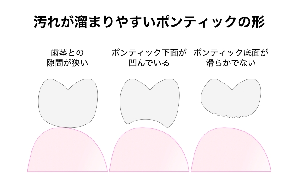 磨き方の問題ではなく「ブリッジの形態」の問題であることが多い