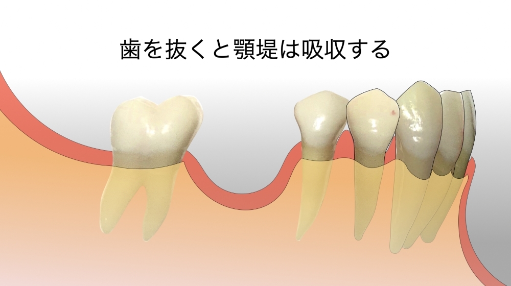 歯を抜くと顎堤は吸収する