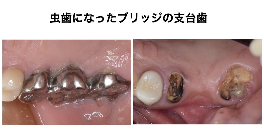 虫歯になったブリッジの支台歯