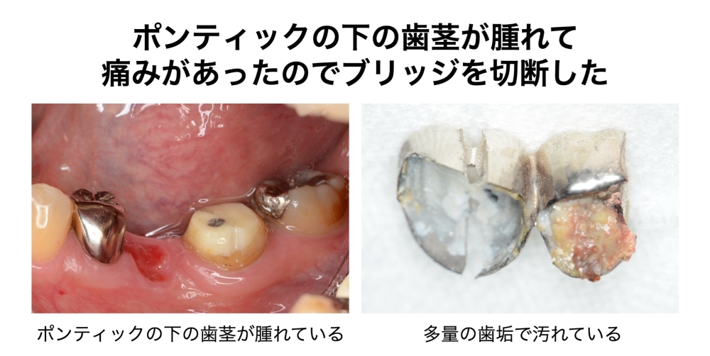 ポンティックの下の歯茎が腫れる