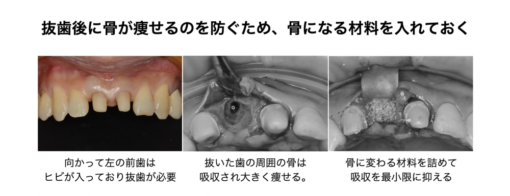 抜歯後の歯槽骨の吸収を抑えるため、抜歯窩に骨補填材を入れた状態