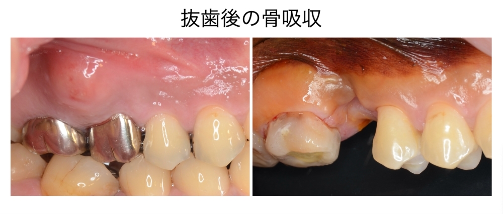 抜歯後の骨吸収