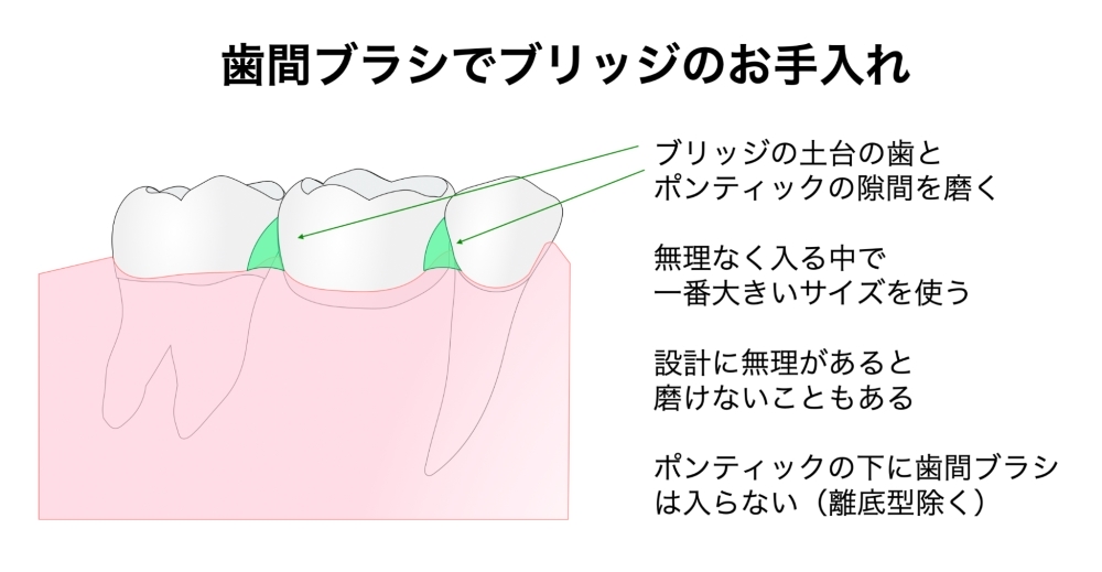 歯間ブラシでブリッジのお手入れ