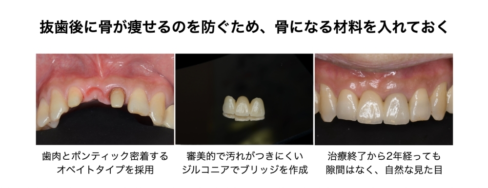 抜歯後に歯槽骨の吸収を抑制するために抜歯窩へ骨補填材を入れておく