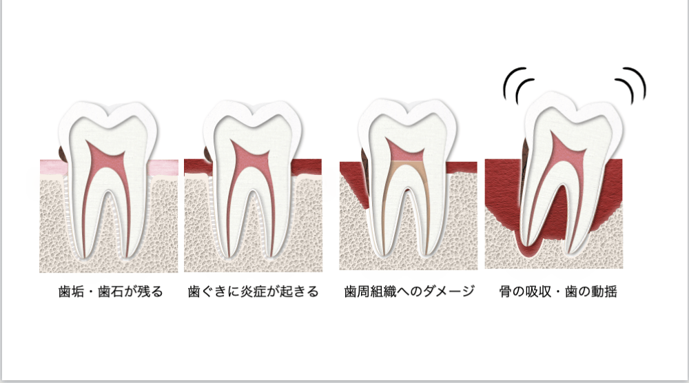 image_tooltip 歯周病