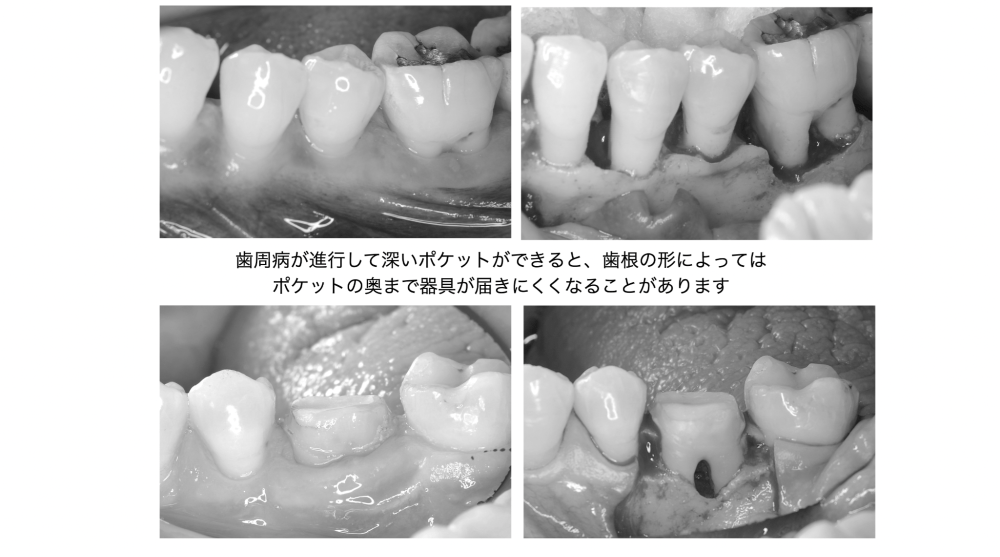 image_tooltip 深いポケットでは、歯根の形によって歯石を取りにくい場所があります